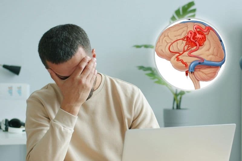 tầm soát dị dạng mạch máu não