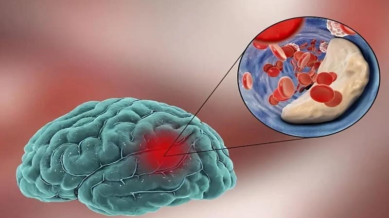 RTPA trong nhồi máu não