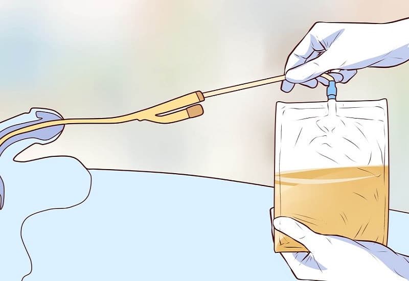 chống chỉ định rửa bàng quang