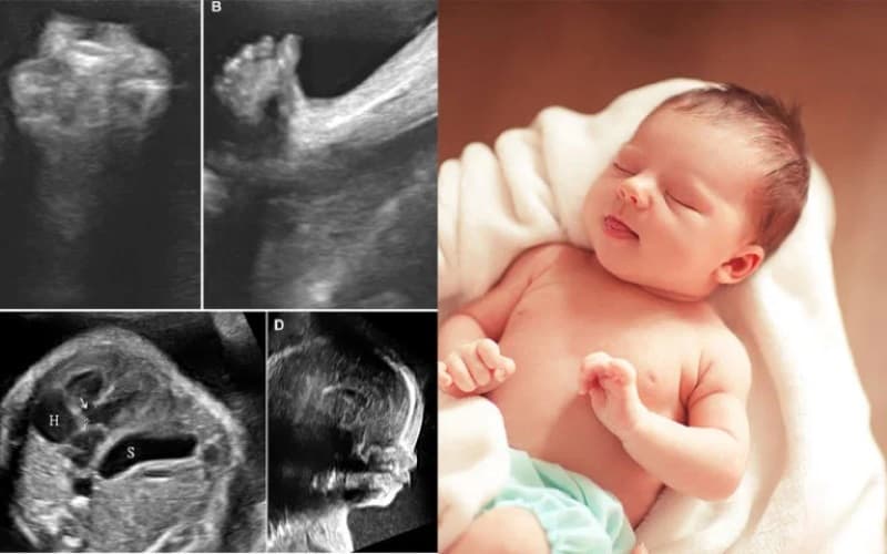 chiều dài xương đùi của thai nhi 33 tuần