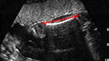 Bảng chiều dài xương đùi thai nhi tuần từ 10-40