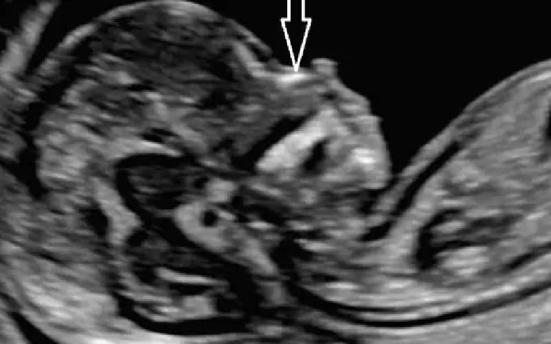 chiều dài xương mũi thai nhi 22 tuần