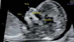 Chiều dài xương mũi thai nhi 24 tuần 7mm có bình thường không?