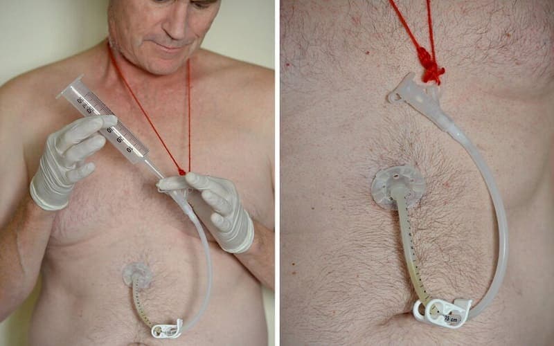 chống chỉ định đặt sonde dạ dày