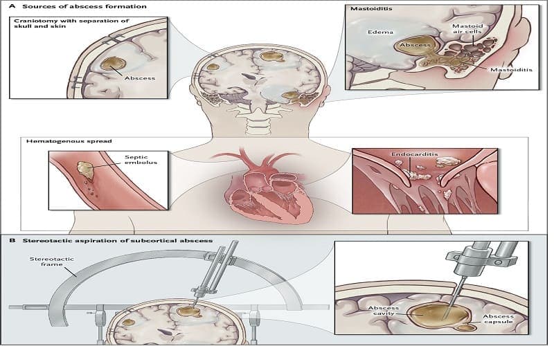 chống chỉ định chọc dịch não tủy