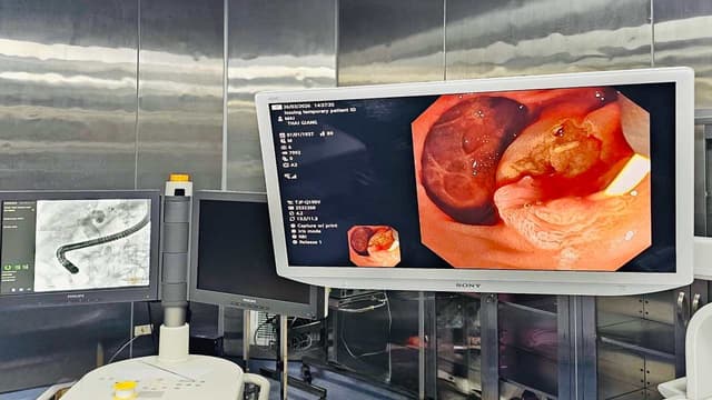 Chống chỉ định ercp (nội soi mật tụy ngược dòng)