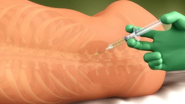 Chống chỉ định gây tê tủy sống