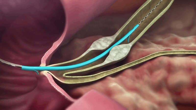 chống chỉ định ercp