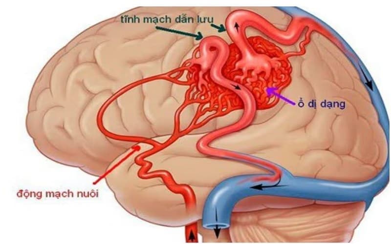 chỉ định tiêu sợi huyết trong nhồi máu não