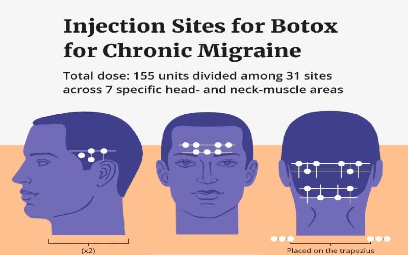 botox chữa đau nửa đầu