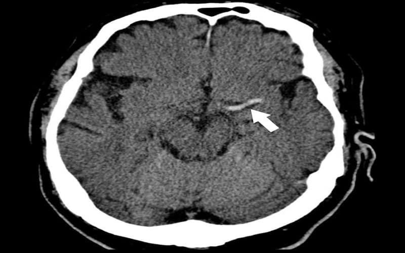 hình ảnh nhồi máu não trên ct