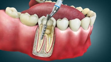 Cần đặt thuốc diệt tủy mấy lần?