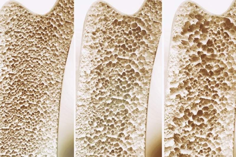 dấu hiệu loãng xương sớm