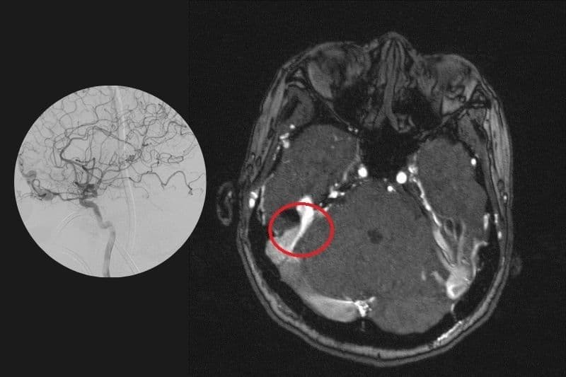tầm soát dị dạng mạch máu não