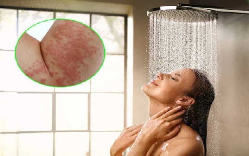 mề đay có được tắm không