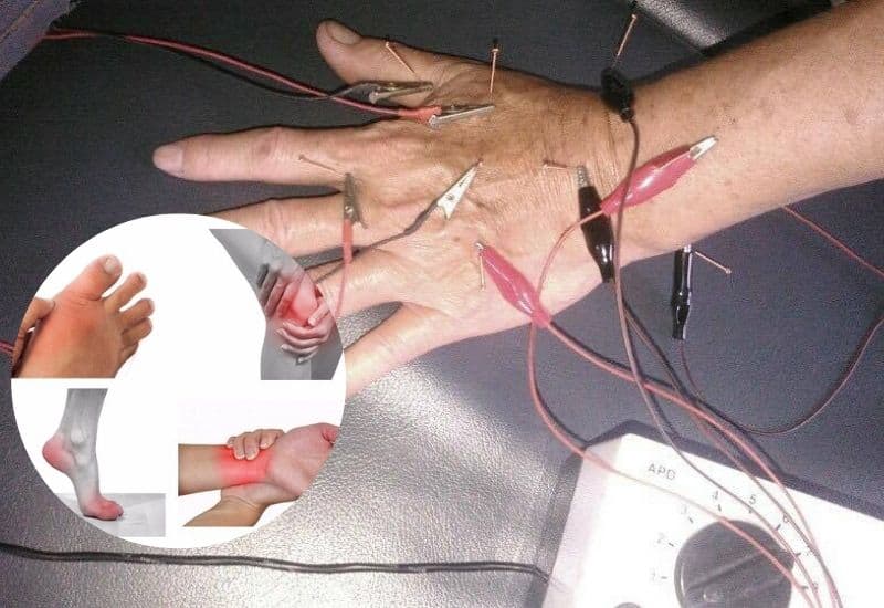 điện châm điều trị viêm khớp dạng thấp