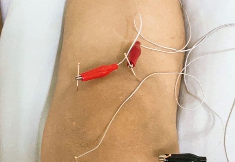 điện châm thoái hoá khớp gối