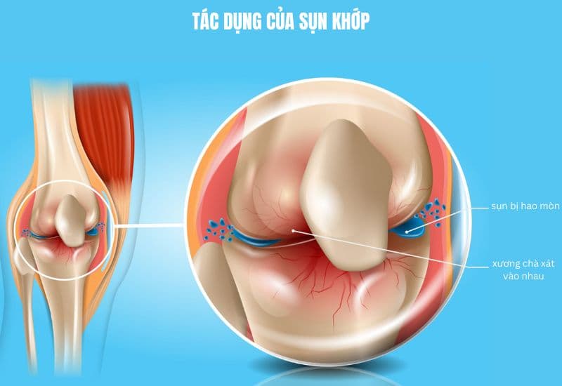 điện châm thoái hoá khớp gối