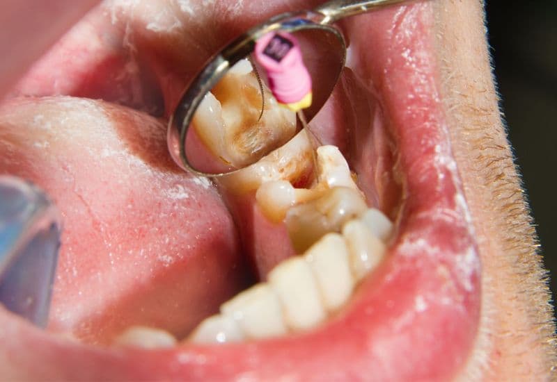 diệt tủy răng là gì