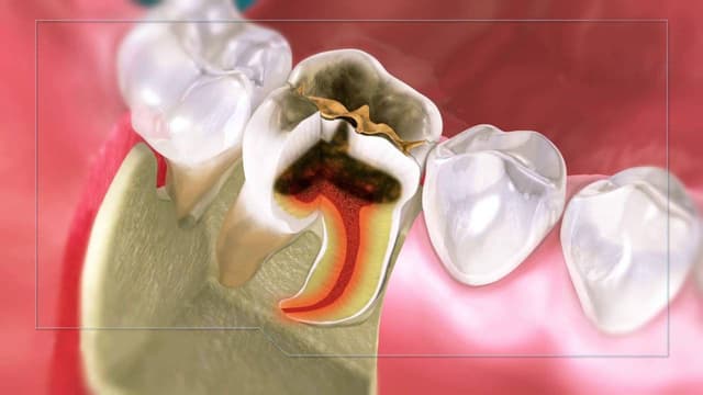 Diệt tủy răng để làm gì?
