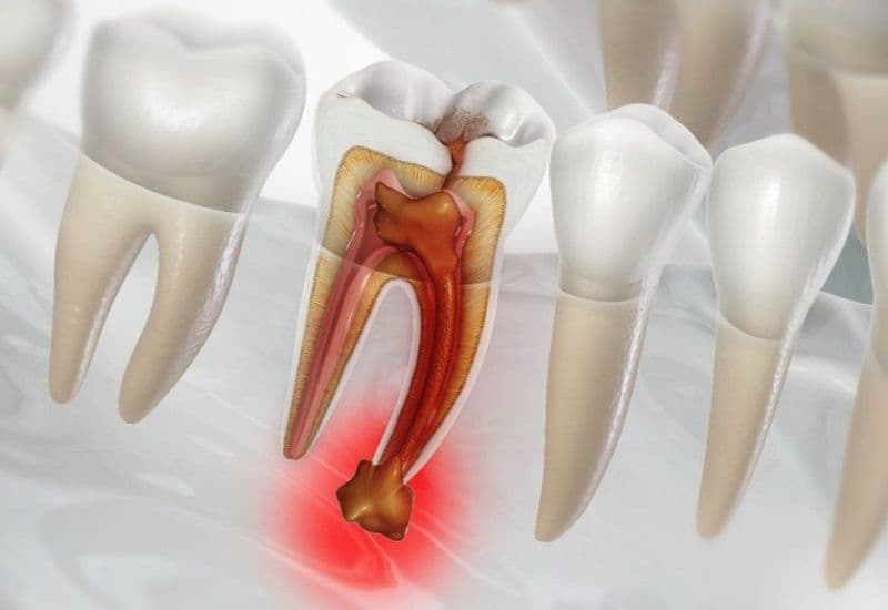 diệt tủy răng số 6