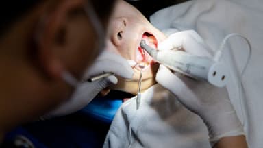 Cách diệt tủy răng số 6