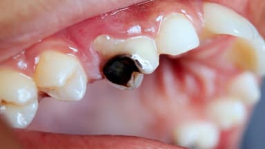 Diệt tủy răng sữa có ảnh hưởng gì không?