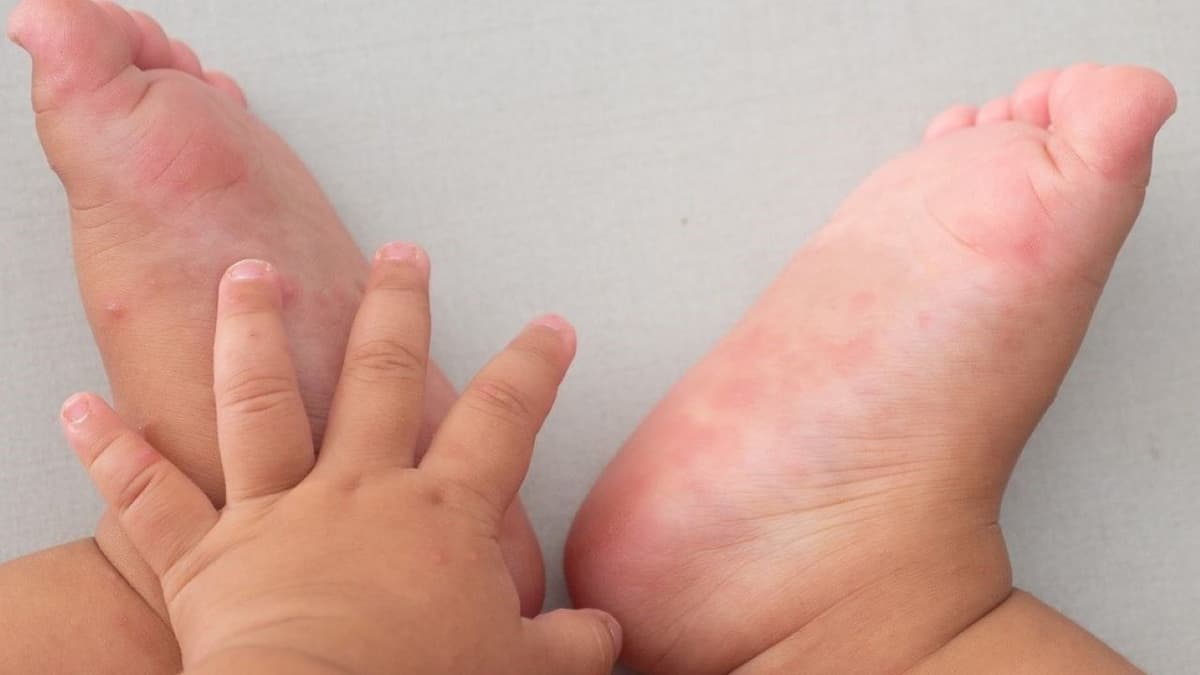 Có thuốc đặc hiệu điều trị tay chân miệng ở trẻ không?