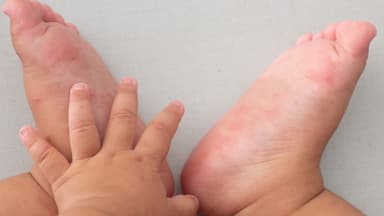 Có thuốc đặc hiệu điều trị tay chân miệng ở trẻ không?