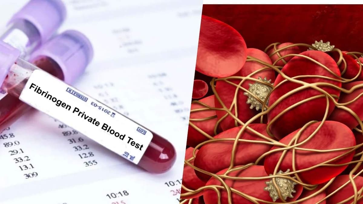 Định lượng Fibrinogen là gì? Giải đáp khi đi khám ngừa đột quỵ