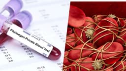 Định lượng Fibrinogen là gì? Giải đáp khi đi khám ngừa đột quỵ