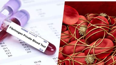 Định lượng Fibrinogen là gì? Giải đáp khi đi khám ngừa đột quỵ
