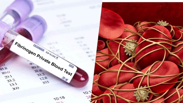 Định lượng Fibrinogen là gì? Giải đáp khi đi khám ngừa đột quỵ