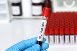 Cách đo tải lượng virus viêm gan B