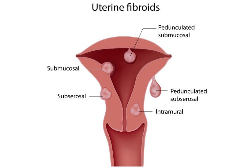 estrogen và u xơ tử cung