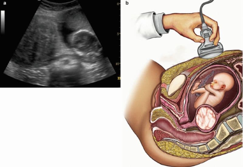 estrogen và u xơ tử cung
