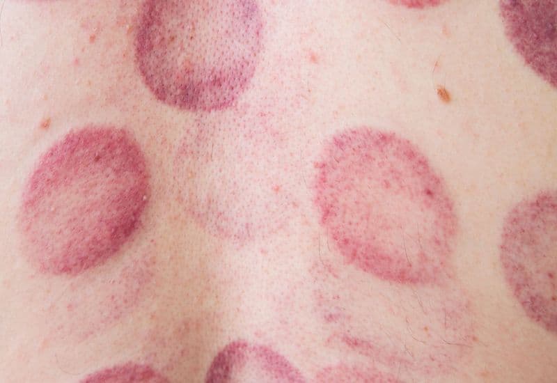 giác hơi có đau không