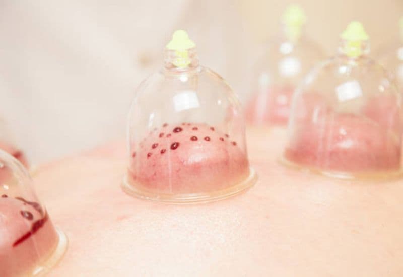 giác hơi cổ vai gáy