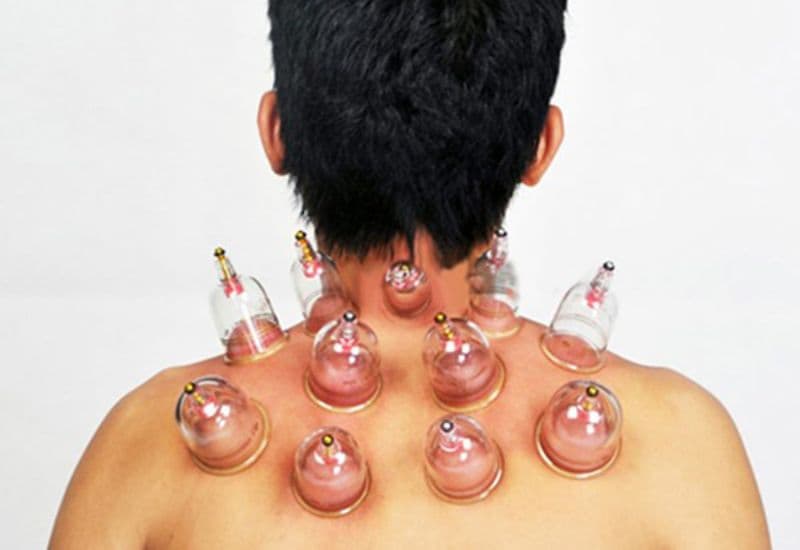 giác hơi giảm đau vai gáy