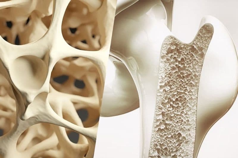 vì sao bị loãng xương