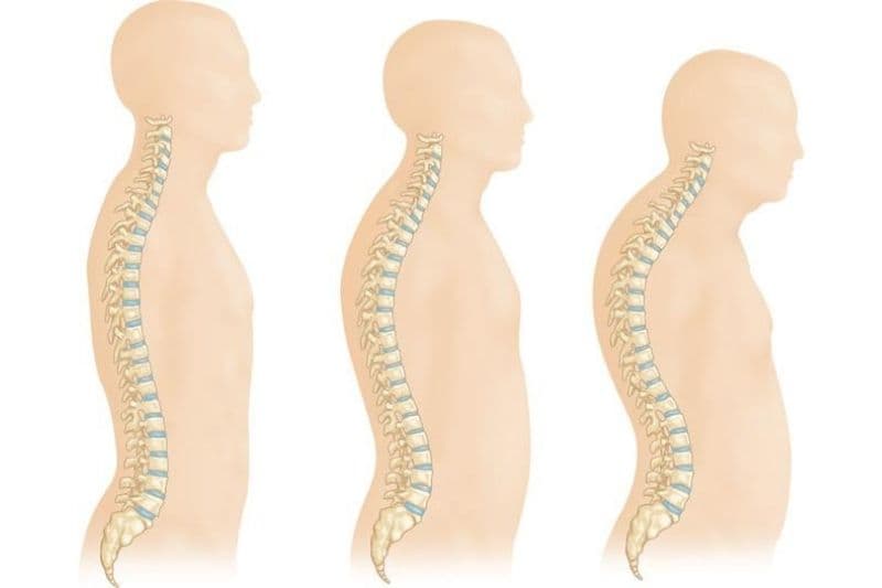 dấu hiệu loãng xương sớm