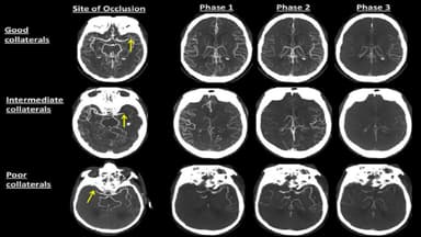 Đặc điểm hình ảnh nhồi máu não trên CT