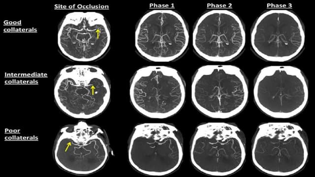 Đặc điểm hình ảnh nhồi máu não trên CT