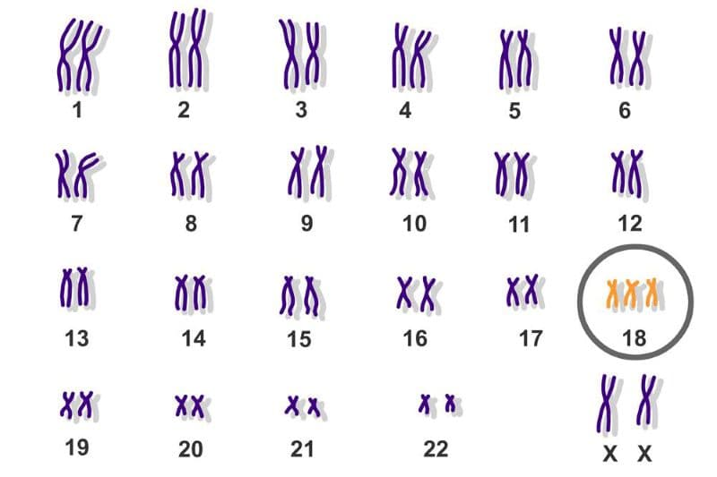 Hội chứng Edwards ảnh hưởng đến con như thế nào?