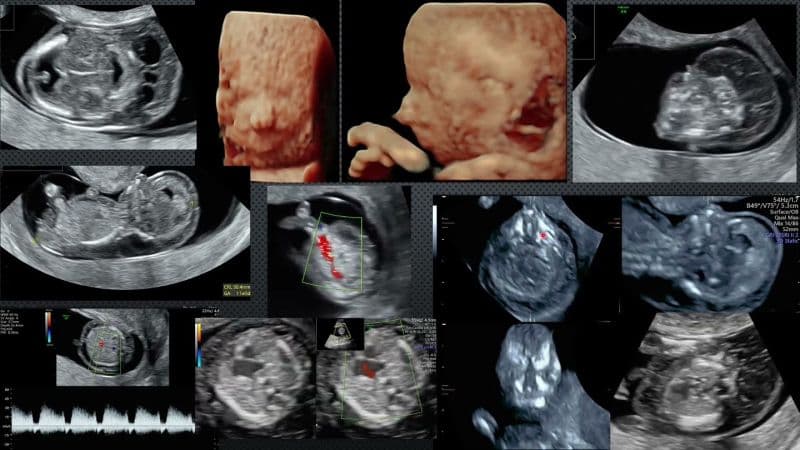 Hội chứng Edwards ảnh hưởng đến con như thế nào?