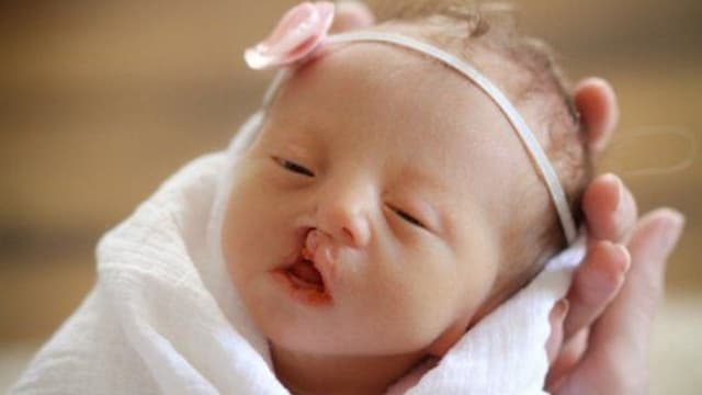 Hội chứng Edwards ảnh hưởng đến con như thế nào?