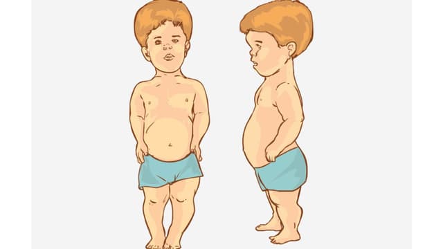 Hội chứng người lùn – Bạn thực sự biết rõ nguy cơ con mình mắc phải?