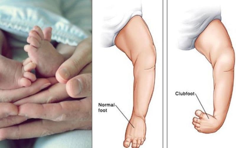 Hội chứng người lùn - Bạn thực sự biết rõ nguy cơ con mình mắc phải?