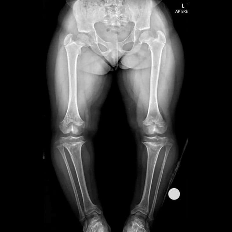 Hội chứng người lùn - Bạn thực sự biết rõ nguy cơ con mình mắc phải?