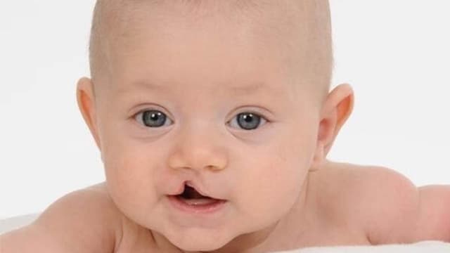 Hội chứng Patau và những điều mẹ phải biết